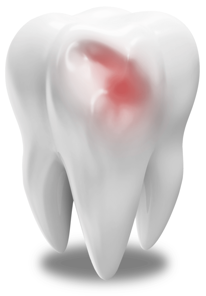 damaged tooth model St. Johns, MI