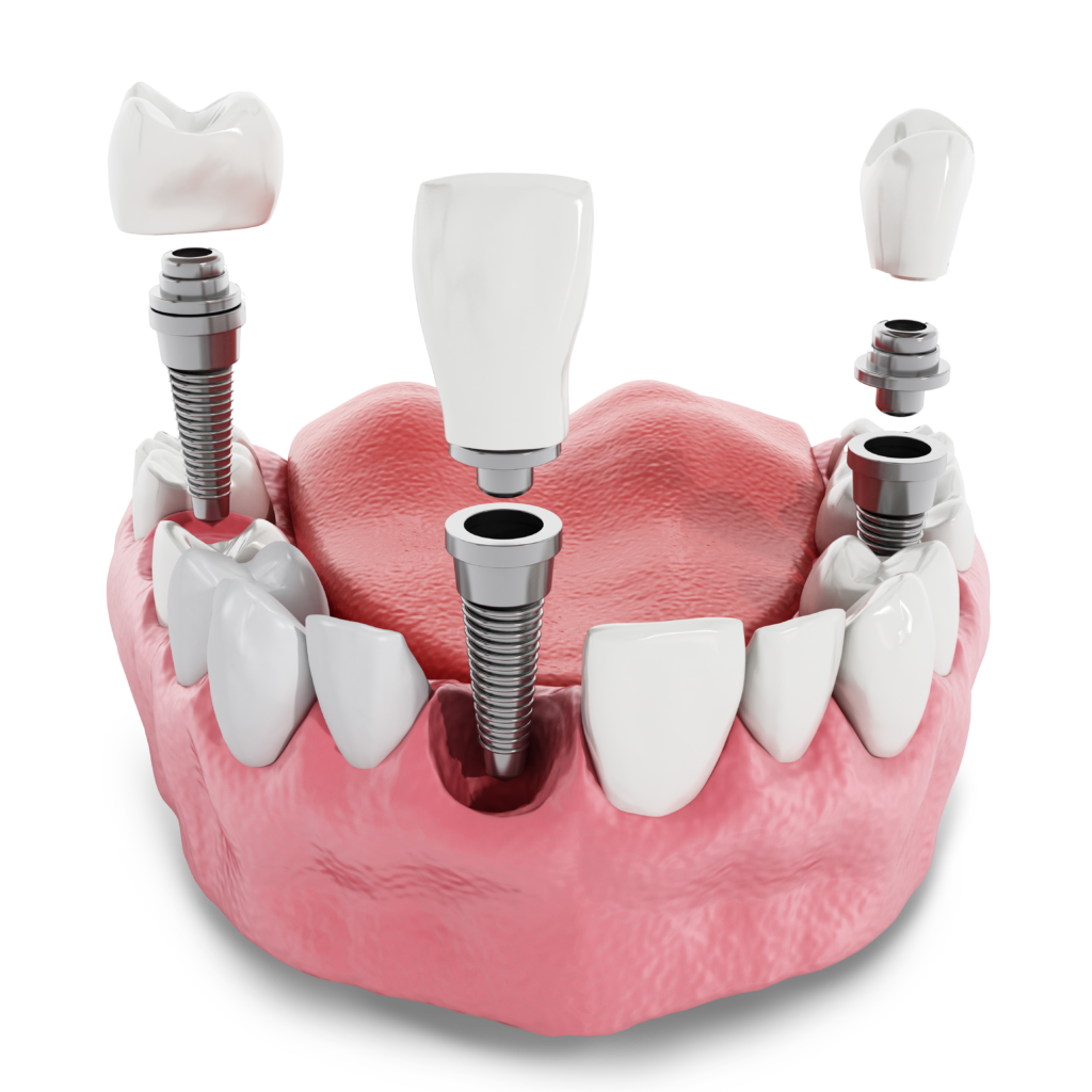 dental implant model St. Johns, MI