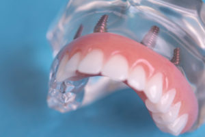 Full Arch Dental Implants