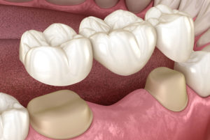 Dental Bridge Model