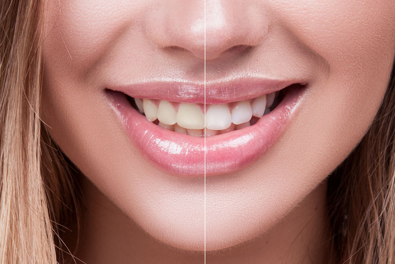 Tooth Whitening Patient Before And After Photo