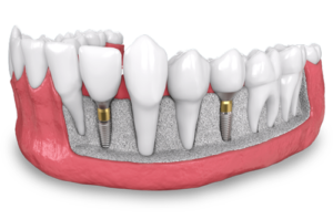 a model of two placed dental implants