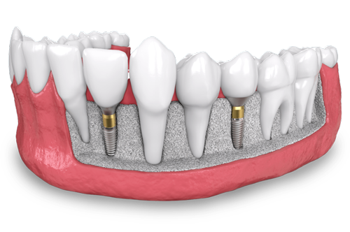 a model of two placed dental implants