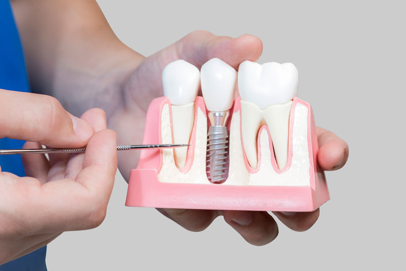 Dental Assistant Showing Off A Dental Implant In A Jawbone Cutaway Model in St. Johns, MI